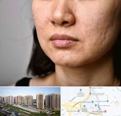 سابسیژن جای جوش در المپیک 