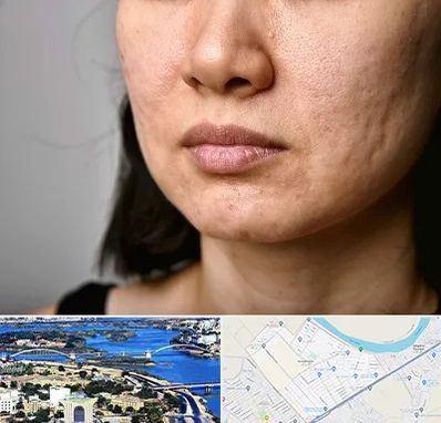 سابسیژن جای جوش در کوروش اهواز