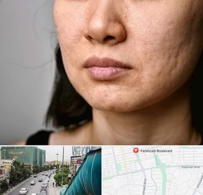 سابسیژن جای جوش در بلوار فرحزادی