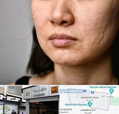 سابسیژن جای جوش در منیریه 