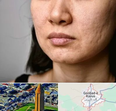 سابسیژن جای جوش در گنبد کاووس