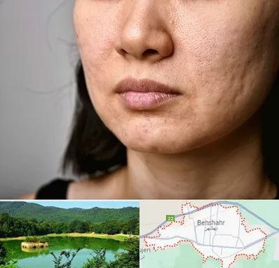 سابسیژن جای جوش در بهشهر