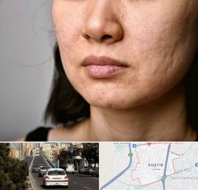 سابسیژن جای جوش در خطیب تبریز