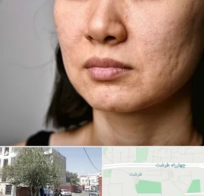 سابسیژن جای جوش در طرشت