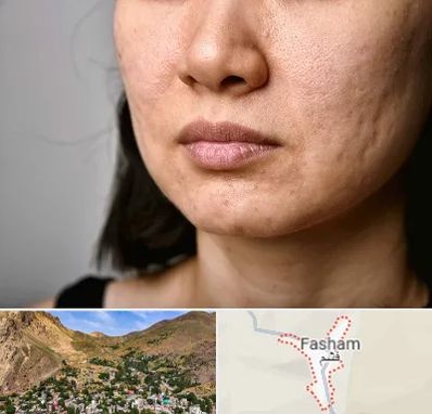 سابسیژن جای جوش در فشم