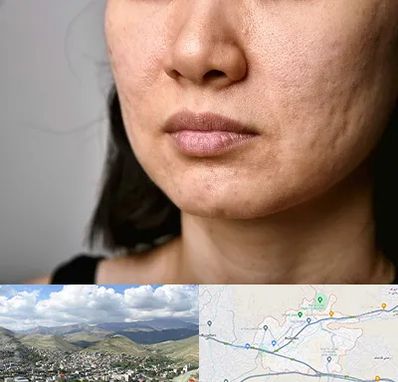 سابسیژن جای جوش در رودهن