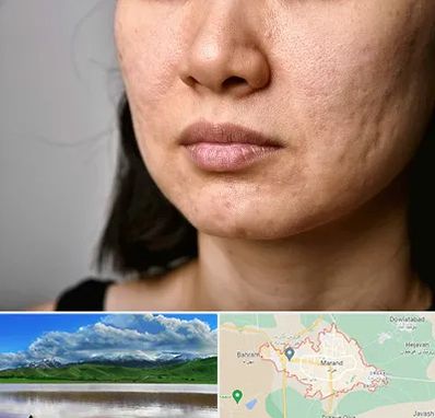 سابسیژن جای جوش در مرند