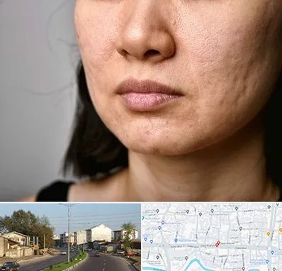 سابسیژن جای جوش در ضیابری رشت