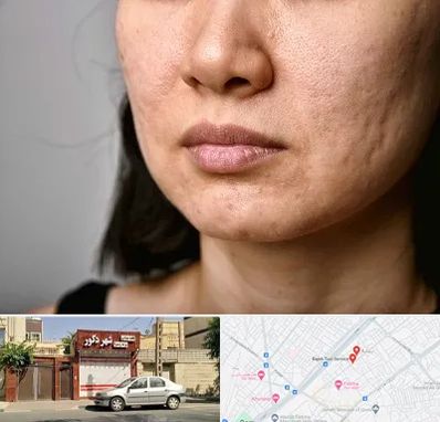 سابسیژن جای جوش در باجک قم