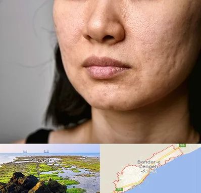 سابسیژن جای جوش در بندرلنگه