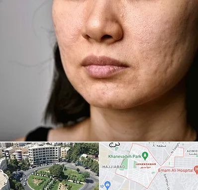 سابسیژن جای جوش در جهانشهر کرج 