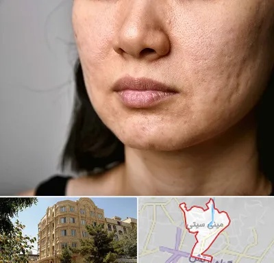 سابسیژن جای جوش در مینی سیتی