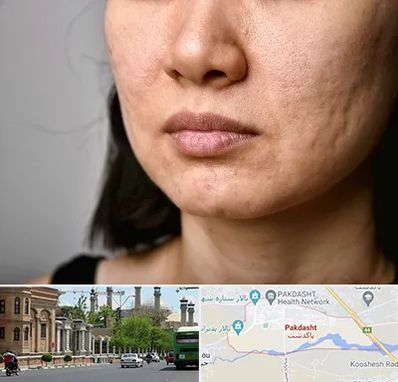 سابسیژن جای جوش در پاکدشت