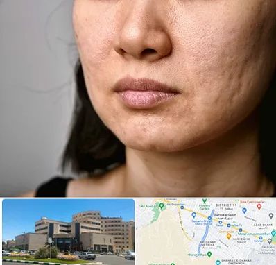 سابسیژن جای جوش در صیاد شیرازی مشهد