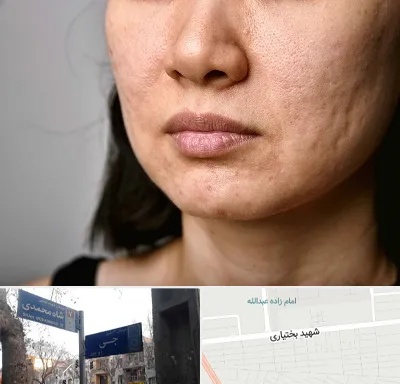 سابسیژن جای جوش در سی متری جی