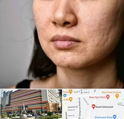 سابسیژن جای جوش در سهروردی 