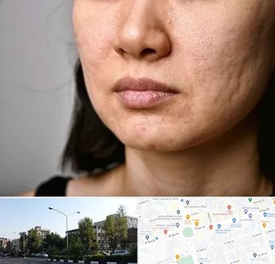 سابسیژن جای جوش در میدان کاج 