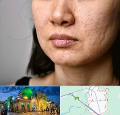 سابسیژن جای جوش در آستانه اشرفیه