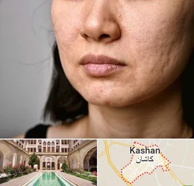 سابسیژن جای جوش در کاشان