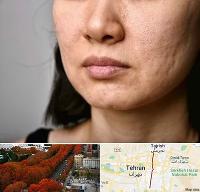 سابسیژن جای جوش در ولیعصر 