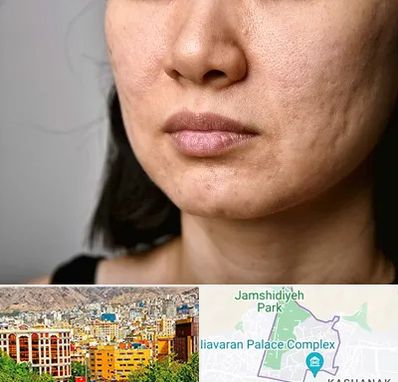 سابسیژن جای جوش در نیاوران 