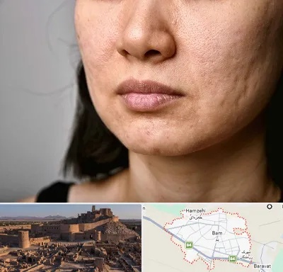 سابسیژن جای جوش در بم