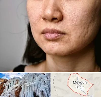 سابسیژن جای جوش در میگون