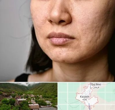 سابسیژن جای جوش در کلاله