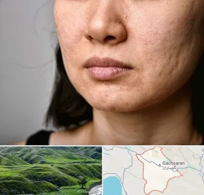 سابسیژن جای جوش در گچساران