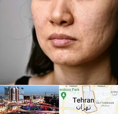 سابسیژن جای جوش در صادقیه 