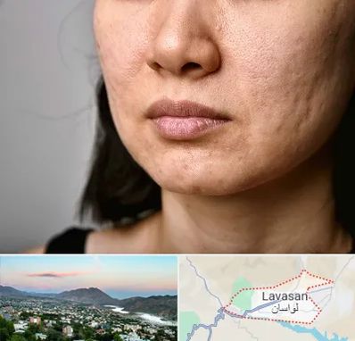 سابسیژن جای جوش در لواسان