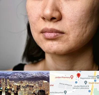 سابسیژن جای جوش در جردن 