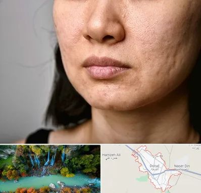 سابسیژن جای جوش در دورود