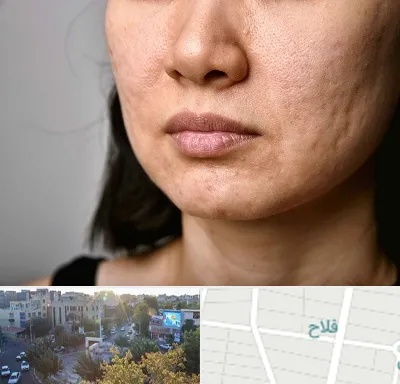 سابسیژن جای جوش در فلاح