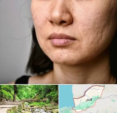 سابسیژن جای جوش در گلستان