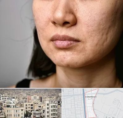 سابسیژن جای جوش در اسکندری