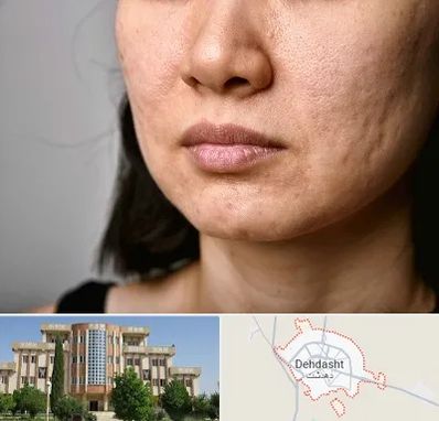 سابسیژن جای جوش در دهدشت