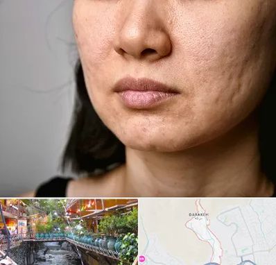 سابسیژن جای جوش در درکه