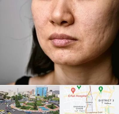 سابسیژن جای جوش در ونک 