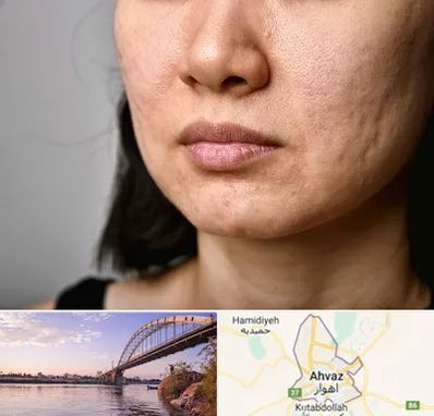 سابسیژن جای جوش در اهواز