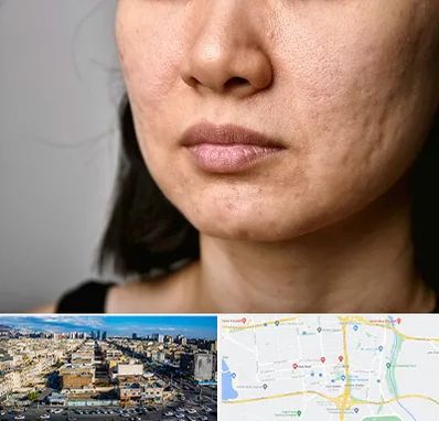 سابسیژن جای جوش در شهرک راه آهن