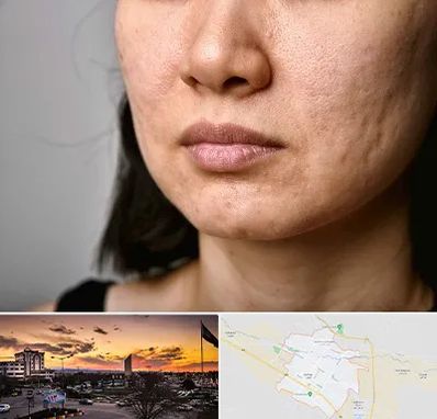 سابسیژن جای جوش در قوچان