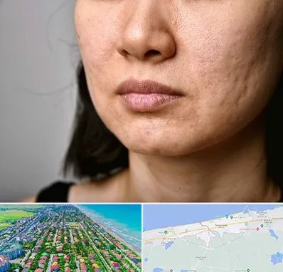 سابسیژن جای جوش در فریدونکنار