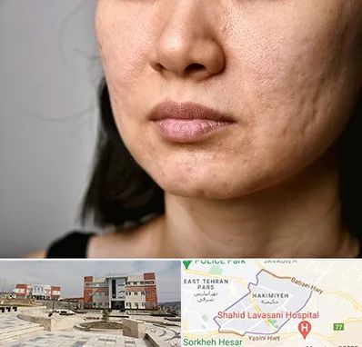 سابسیژن جای جوش در حکیمیه 