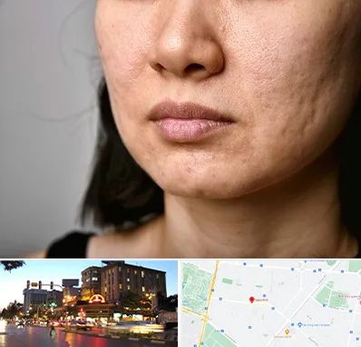 سابسیژن جای جوش در بلوار سجاد مشهد 