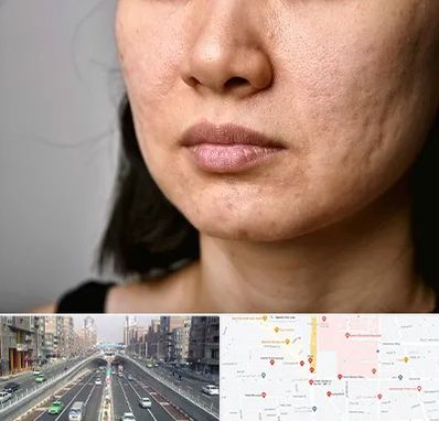 سابسیژن جای جوش در توحید 