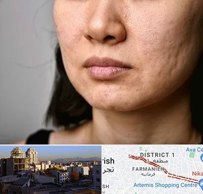 سابسیژن جای جوش در فرمانیه 