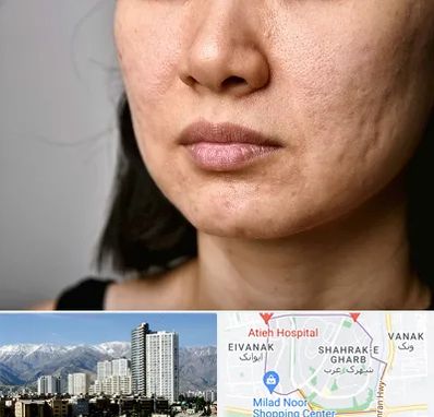 سابسیژن جای جوش در شهرک غرب 