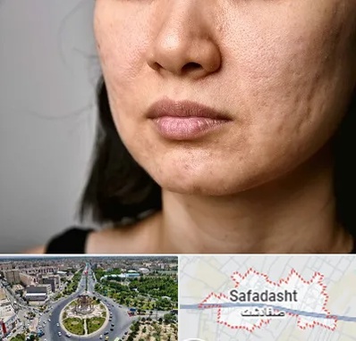 سابسیژن جای جوش در صفادشت