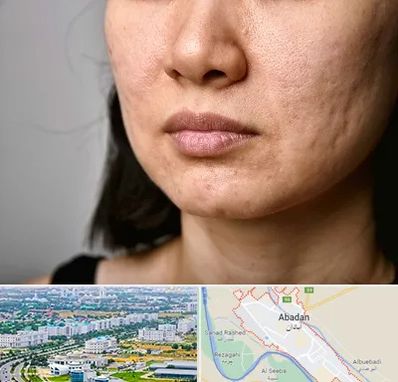 سابسیژن جای جوش در آبادان